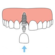 Replace one tooth
