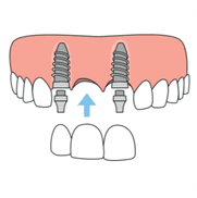 Replace multiple teeth