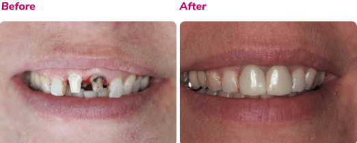 Before and after dental implant case 1