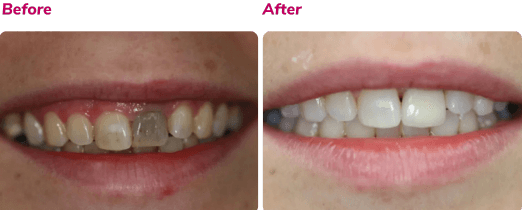 Before and after dental implant case 2