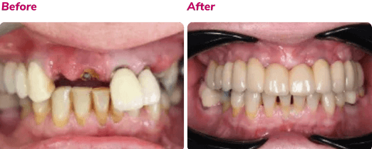 Before and after dental implant case 3