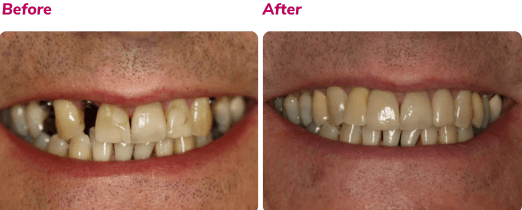 Before and after dental implant case 4