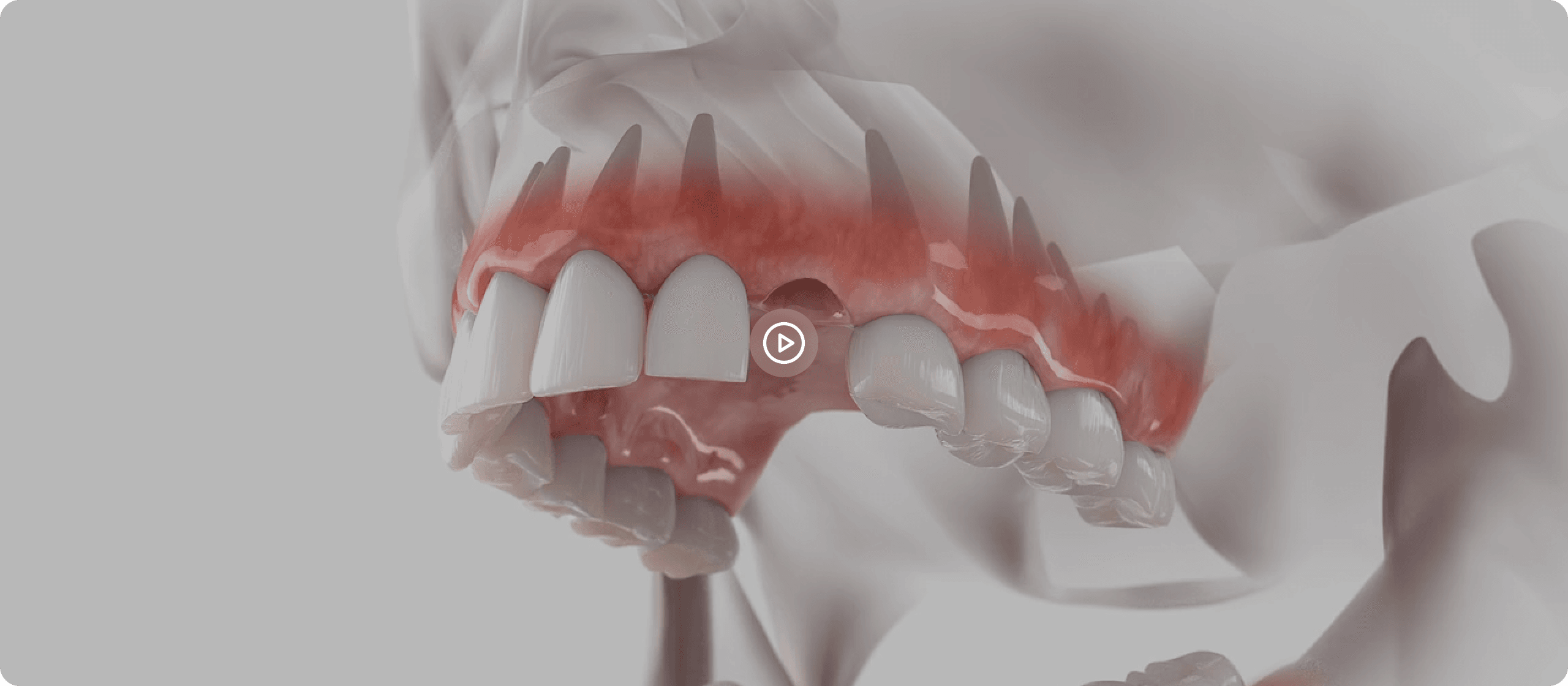 Dental implant explainer